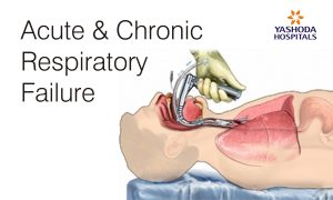acute and chronic respiratory failure