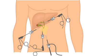 surgical treatment of gallbladder