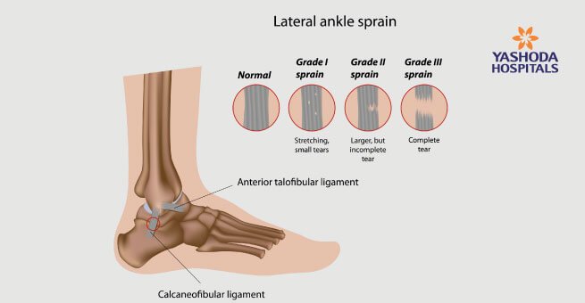 Ligament injuries