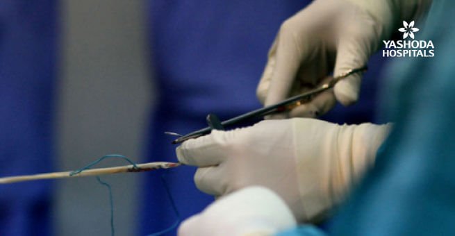surgical procedure for ACL surgery