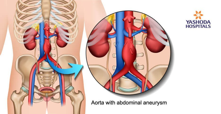 Abdominal aortic aneurysm causes and treatment