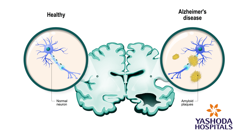 Abnormal beta amyloid plaques are hallmarks of Alzheimer’s disease