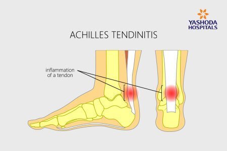 Achilles Tendinitis: What are the Symptoms, Risk Factors and Complications