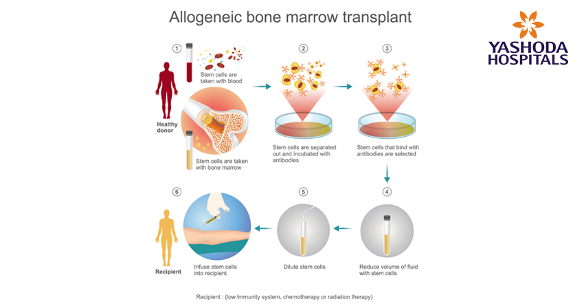 Allogenic stem cell transplant
