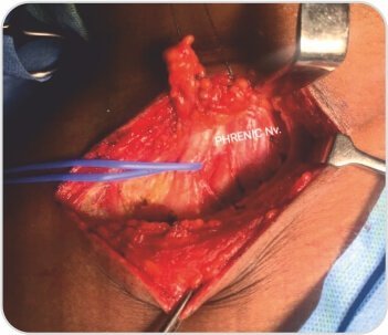 Case of Arterial Thoracic Outlet Syndrome