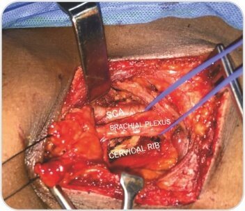 Case of Arterial Thoracic Outlet Syndrome