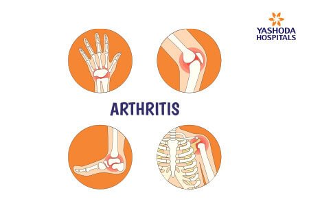 Arthritis: Types and Causes