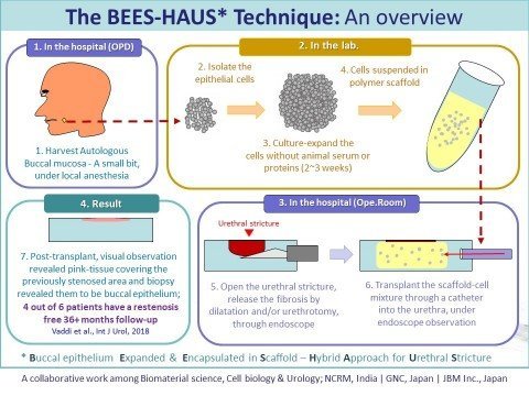 BEES-HAUS, an illustrative overview of the steps from tissue harvest to cell transplant for urethral stricture and a glimpse of the results (Graphic: Business Wire)