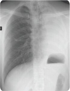 Balloon Bronchoplasty of Tubercular Stenosis