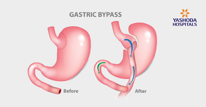 Gastric Bypass surgery help in weight loss
