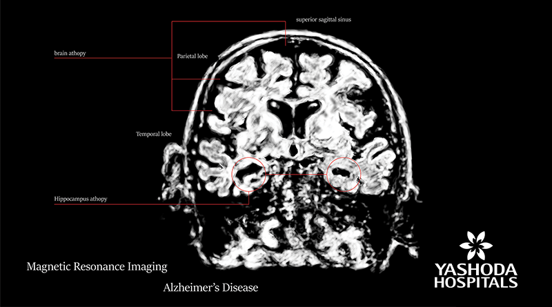 Brain imaging for diagnosing Alzheimer’s disease