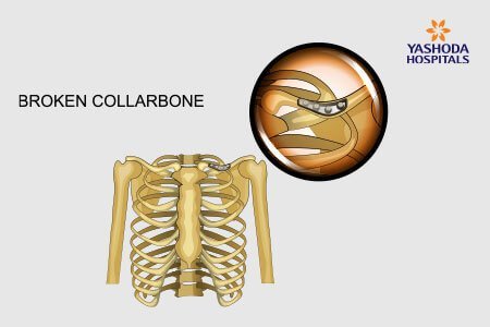 Broken Collarbone: What is Broken Collarbone, its Causes?