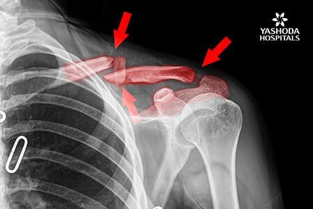 Broken Collarbone: Symptoms and Complications