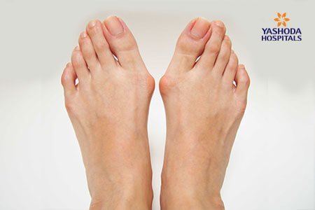 Bunions: What is OBunions, its Causes?