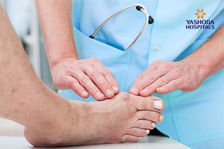 Bunions: Diagnosis, Prevention and Treatment