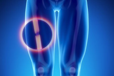 Symptoms, Risk Factors and Complications of Burning Thigh Pain