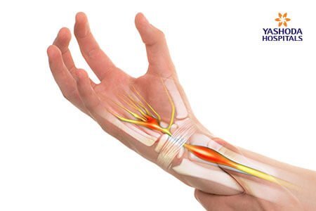Carpal Tunnel Causes