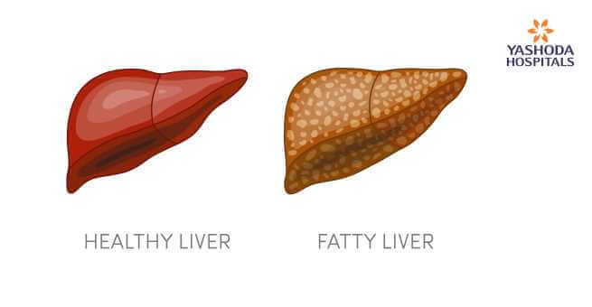 What Causes Liver Cancer?