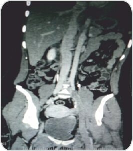 A Challenging Case of Left Leg DVT in A Young Girl