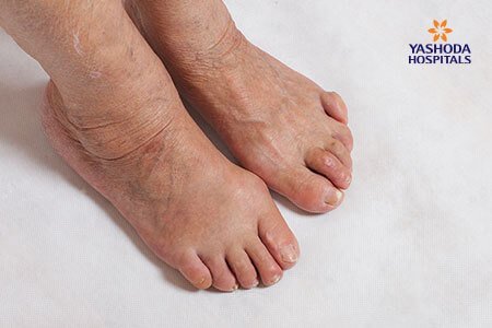 Claw Toe: What is Claw Toe, its Causes?