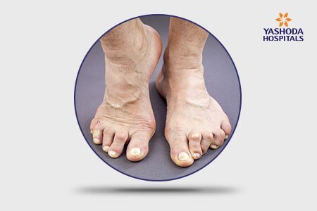 Claw Toe: Symptoms, Risk Factors and Complications