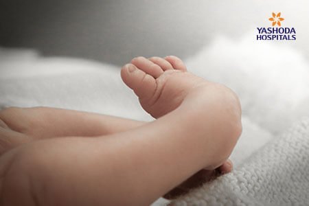 Clubfoot: What is Clubfoot its Causes?
