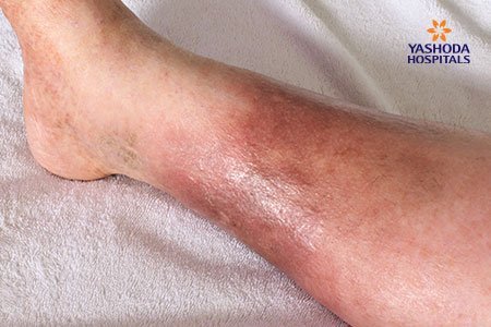 Compartment Syndrome and it's Causes