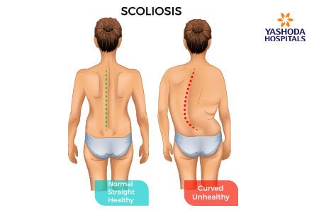 Congenital Scoliosis Complications