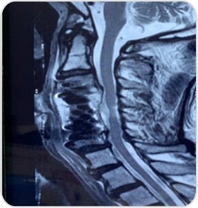 Post op MRI showing significant cord decompression