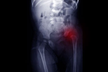 Symptoms, Risk Factors and Complications of Developmental Dysplasia Of The Hip