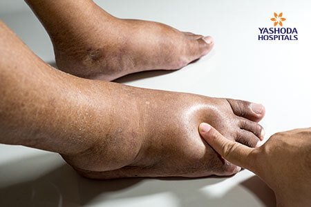 Diabetic Charcot Foot: Symptoms and Complications