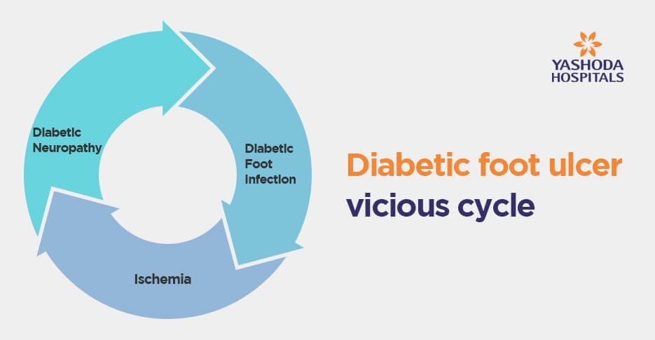 Diabetic foot ulcer vicious cycle