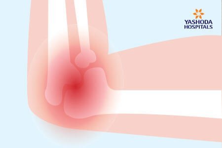 Elbow (Olecranon) Bursitis: Symptoms and Complications