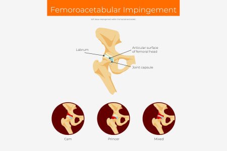 Femoroacetabular Impingement and it's Causes