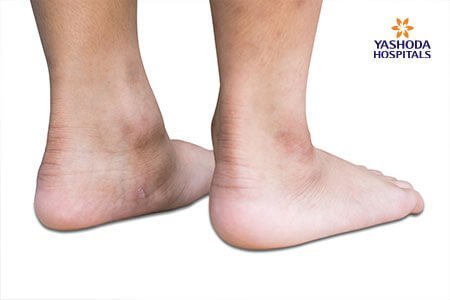 Flexible Flatfoot in Children: What is Flexible Flatfoot in Children, its Causes?