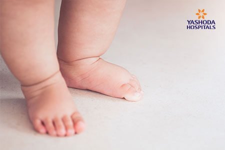 Flexible Flatfoot in Children: Symptoms and Complications