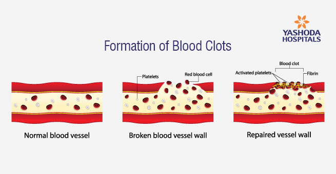 Formation of blood clots