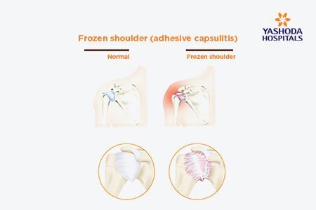 Frozen Shoulder: What is Osteopenia, its Causes?