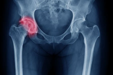 Symptoms and Complications of Hip Bursitis