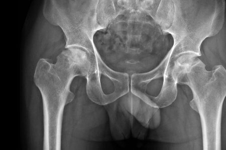 Hip Osteonecrosis: Symptoms, Risk Factors and Complications