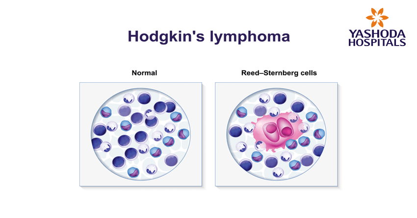 Hodgkin’s lymphoma