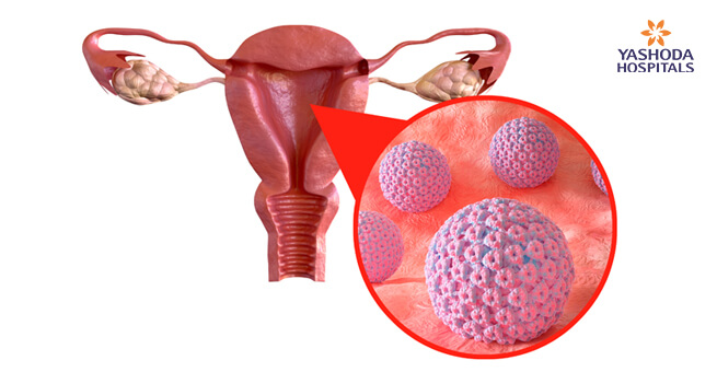 How do you get cervical cancer