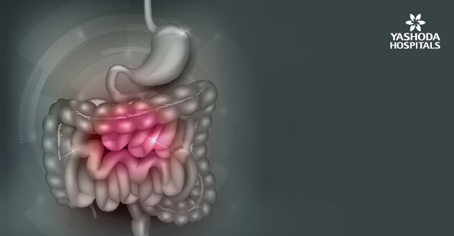 How is IBS diagnosed