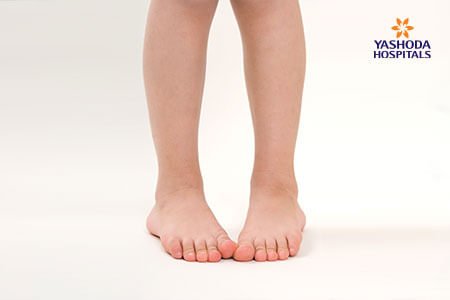 Intoeing: What is Ingrown Toenail, its Causes?