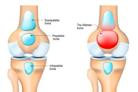 Knee Tendon Bursitis and it's Causes