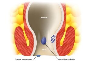 Know About hemorrhoids or Piles