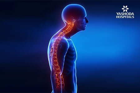 Kyphosis of the Spine causes