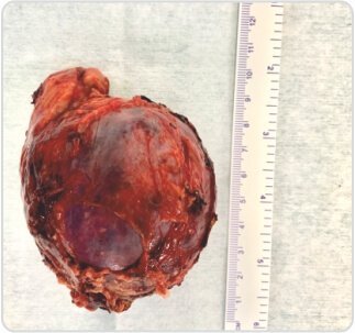 Left Adrenal Tumour Excision