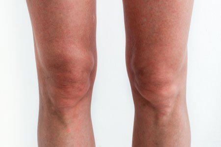 Symptoms and Complications of Limb Length Discrepancy