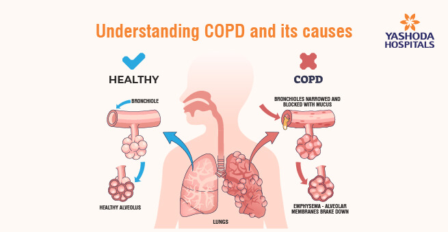 Living-with-COPD1